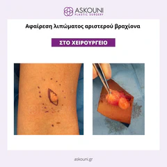 Removal of Lipoma - Arm | Before & After