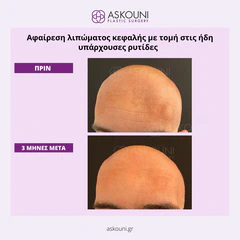 Removal of Lipomas - Head | Before & After