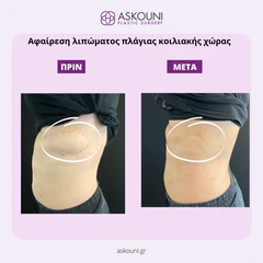 Removal of Lipoma - Abdomen | Before & After