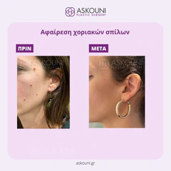 Removal of Moles - Face | Before & After