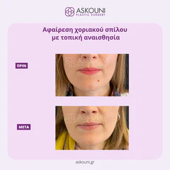 Removal of Mole - Face | Before & After