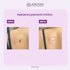 Removal of Mole - Back | Before & After