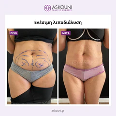 Fat Removal (Aqualyx) - Female | Before & After