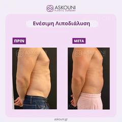 Fat Removal (Aqualyx) - Male | Before & After