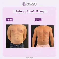 Fat Removal (Aqualyx) - Male | Before & After