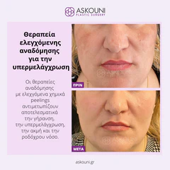 Peeling Therapy for Hyperpigmentation | Before & After