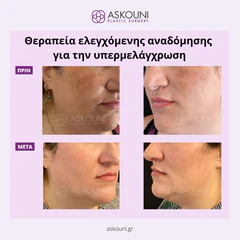 Peeling Therapy for Hyperpigmentation | Before & After