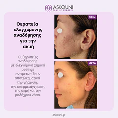 Peeling Therapy for Acne | Before & After