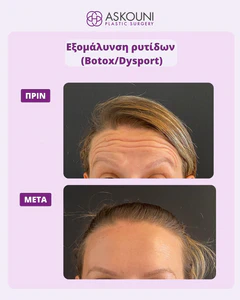 Anti-wrinkle Injections for Forehead Wrinkles | Before & After