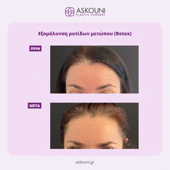 Anti-wrinkle Injections for Forehead Wrinkles | Before & After