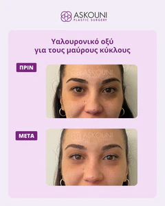 Dark Circles Treatment | Before & After