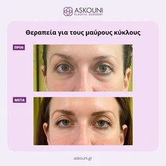 Dark Circles Treatment | Before & After