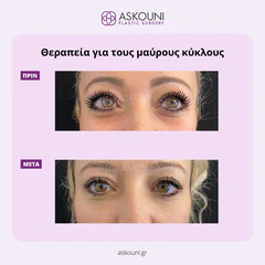 Dark Circles Treatment | Before & After