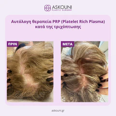 Hair Loss PRP Therapy - Female | Before & After