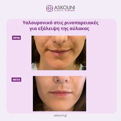 Filler - Face | Before & After