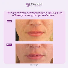 Filler - Face | Before & After