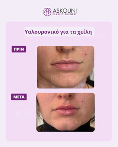 Lips Augmentation using Filler | Before & After