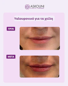 Lips Augmentation using Filler | Before & After