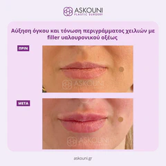 Lips Augmentation using Filler | Before & After