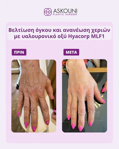 Antiageing Hands Treatment | Before & After