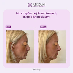 Liquid Rhinoplasty | Before & After