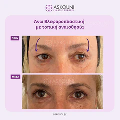 Upper Blepharoplasty under Local Anaesthesia - Female | Before & After