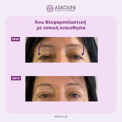 Upper Blepharoplasty under Local Anaesthesia - Female | Before & After