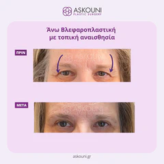 Upper Blepharoplasty under Local Anaesthesia - Female | Before & After
