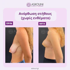 Breast Lift | Before & After