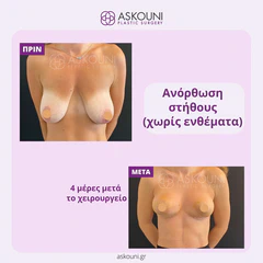 Breast Lift | Before & After
