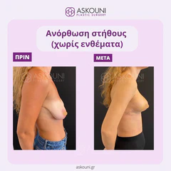 Breast Lift | Before & After