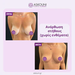 Breast Lift | Before & After