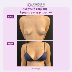 Breast Augmentation | Before & After