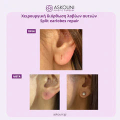 Split Earlobe Reconstruction | Before & After