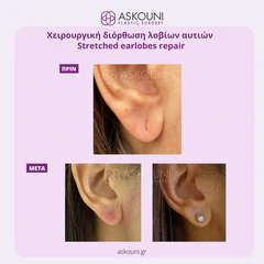 Split Earlobe Reconstruction | Before & After