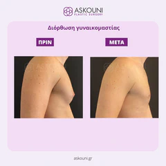 Gynecomastia | Before & After