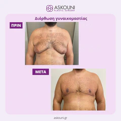 Gynecomastia | Before & After
