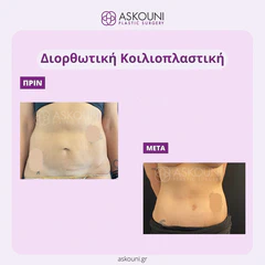 Corrective Abdominoplasty - Female | Before & After