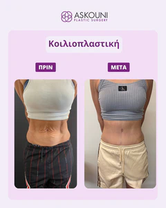 Corrective Abdominoplasty - Female | Before & After