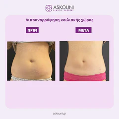 Abdominal Liposuction - Female | Before & After