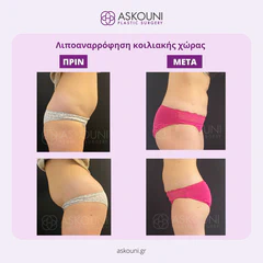 Abdominal Liposuction - Female | Before & After