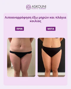 Abdominal Liposuction - Female | Before & After