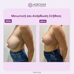 Breast Reduction & Lift | Before & After