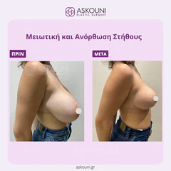 Breast Reduction & Lift | Before & After