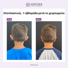 Otoplasty - Child | Before & After