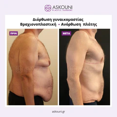 Post-Bariatric Surgery (After Weight Loss) | Before & After