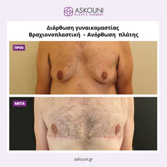 Post-Bariatric Surgery (After Weight Loss) | Before & After