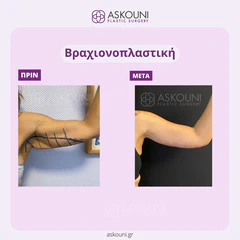 Brachioplasty - Female | Before & After