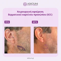 Αφαίρεση Δερματικού Καρκίνου - Πρόσωπο | Πριν & Μετά