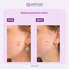 Αφαίρεση Χοριακού Σπίλου - Πρόσωπο | Πριν & Μετά